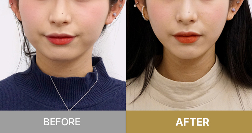 V-CAT + Cheekbone CAT /  Vキャット+頬骨キャット